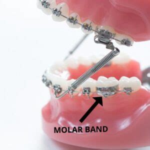 can you bond bracket to metal band|Metal Molar Bands for Braces: Everything You Need to Know.